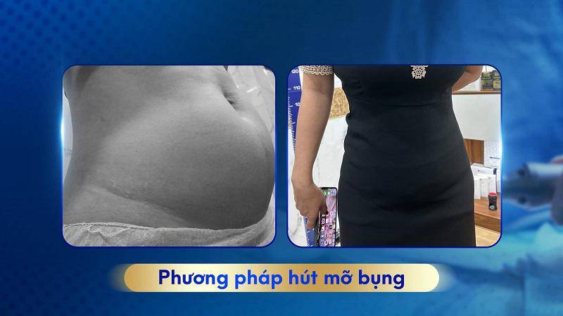 hut-mo-co-nguy-hiem-khong-3.jpg